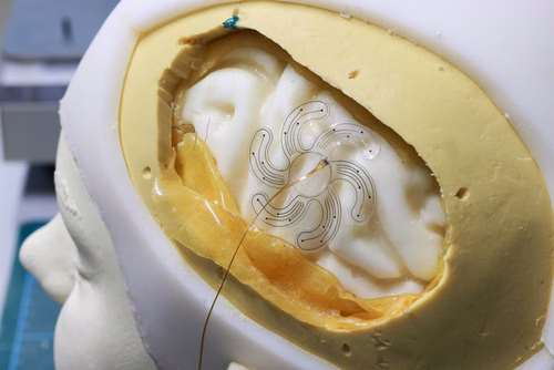 Des scientifiques de l’EPFL ont développé un réseau d’électrodes déployable au-dessus d’une relativement large surface du cortex cérébral, à travers un petit trou percé dans le crâne. La technologie pourrait fournir une solution minimalement invasive pour des patients épileptiques. Sukho Song et Stéphanie Lacour, professeure à l’institut Neuro X de l’EPFL, avec l'électrode déployable.