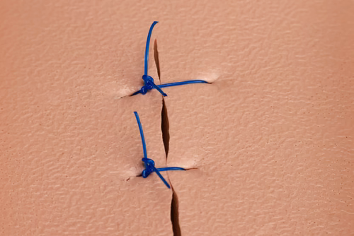 Des scientifiques de l’EPFL ont publié une première étude sur la mécanique des nœuds chirurgicaux. Les résultats pourraient servir à former les chirurgiennes et chirurgiens à la réalisation de sutures plus solides et plus sûres – une compétence dont la maîtrise nécessite généralement des années de pratique.
